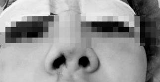 隆鼻手術(shù)術(shù)前效果