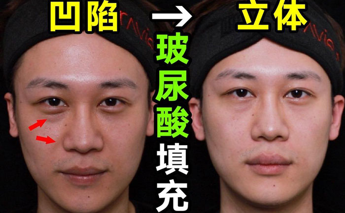 淚溝填充用什么方法最好？淚溝填充手術(shù)大約多少錢？