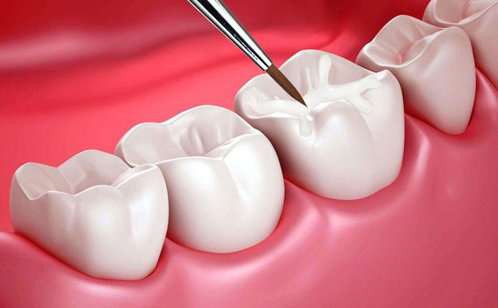 貴金屬烤瓷牙有哪些？貴金屬烤瓷牙的種類