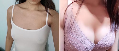 假體隆胸手術(shù)效果對比圖3