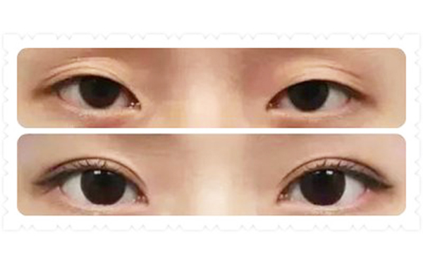 韓式三點雙眼皮價格是多少?術(shù)后為什么變成多眼皮?