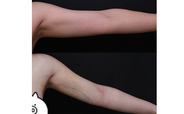 手臂吸脂的過程是什么?效果怎么樣?