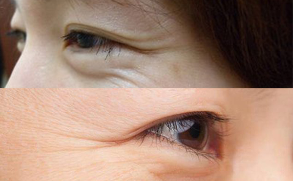 魚尾紋有哪幾種類型？