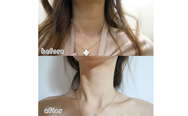 超聲刀去頸紋能維持多久？