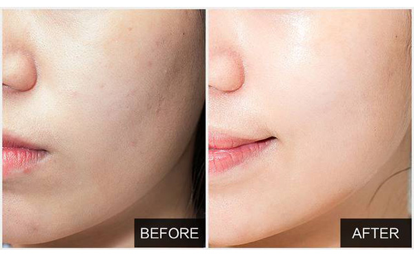 水光針能維持多久？