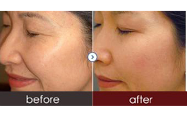 水光針有副作用嗎？