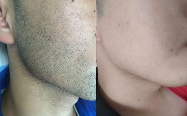 冰點(diǎn)面部脫毛效果怎么樣？