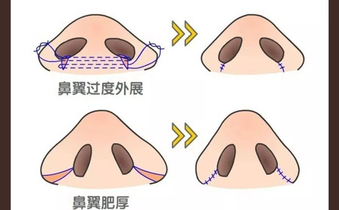 鼻頭肥大怎么改善？鼻頭肥大矯正術(shù)多少錢？
