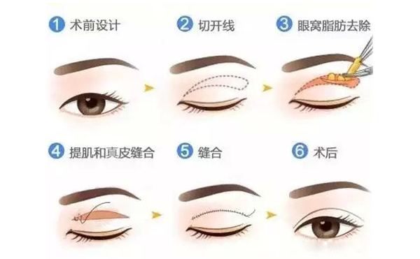 全切雙眼皮跟埋線的區(qū)別是什么？哪個(gè)好？