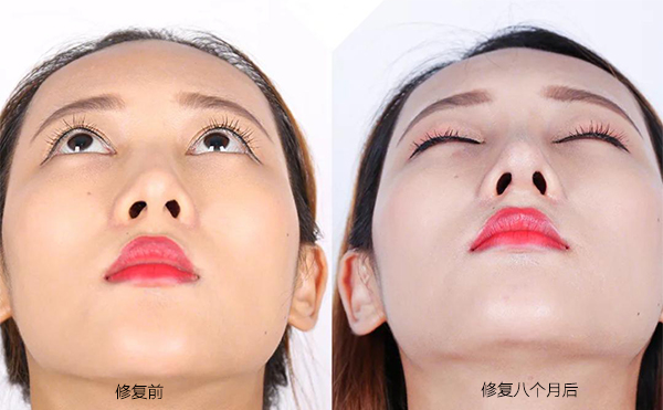 隆鼻手術(shù)失敗怎么辦？修復費用要多少？