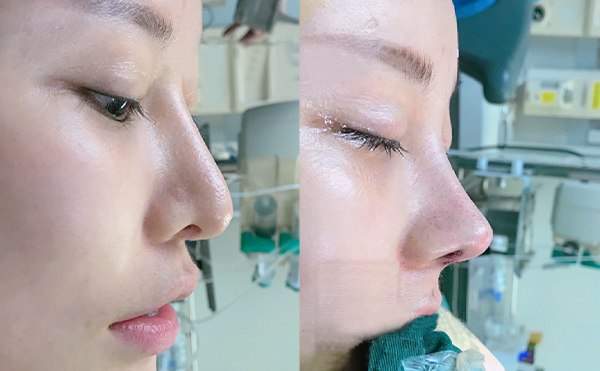 隆鼻失敗的原因是什么？隆鼻修復(fù)方法有哪些？