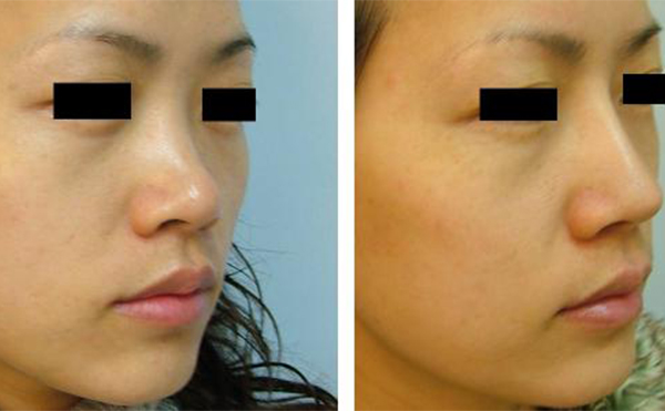 隆鼻手術有沒有什么后遺癥？