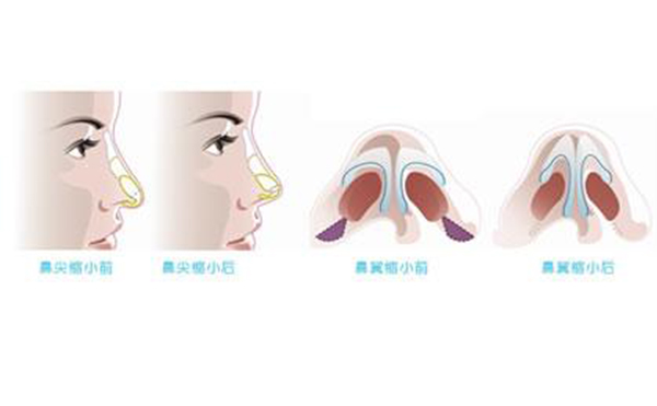 鼻翼縮小整形安全嗎？術(shù)后會(huì)不會(huì)影響呼吸