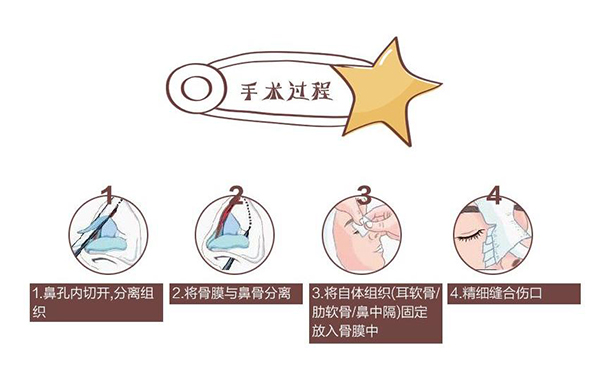 自體軟骨隆鼻為什么這么受歡迎？