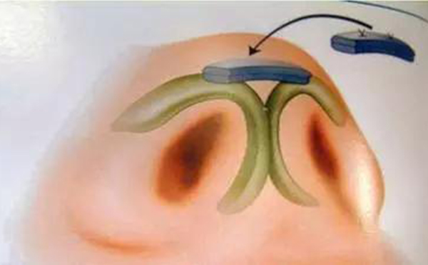 鼻小柱缺損修復(fù)手術(shù)有風(fēng)險(xiǎn)嗎?術(shù)前注意事項(xiàng)有哪些?