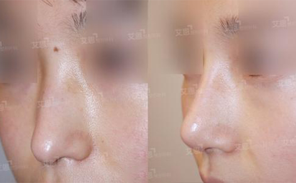 長鼻是畸形鼻嗎?鼻子過長的矯正方法是什么?