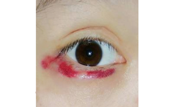 自體脂肪豐臥蠶有風險嗎?術(shù)后怎么護理?