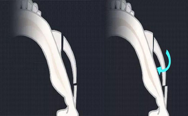 顴骨內(nèi)推是什么？