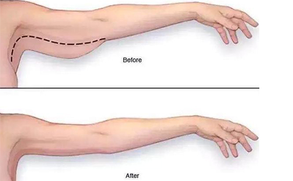 手臂吸脂需要多長時間恢復(fù)？