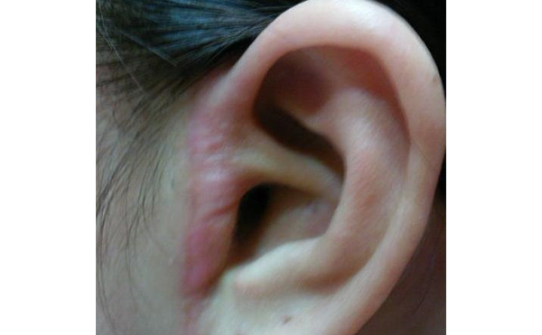 拉皮痕跡明顯嗎？