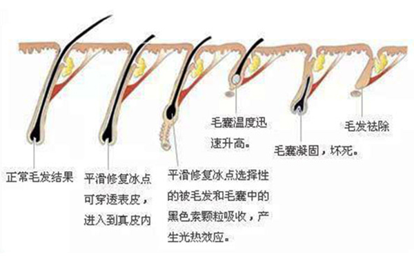 面部冰點(diǎn)脫毛會(huì)反彈嗎?不到半年又長(zhǎng)了是怎么回事?