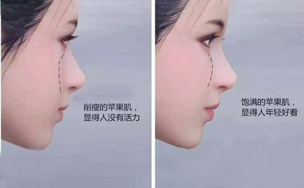 蘋果肌凹陷怎么辦？