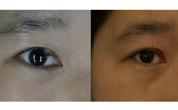 先天性眼瞼缺損會遺傳嗎?先天性眼瞼缺損怎么辦?