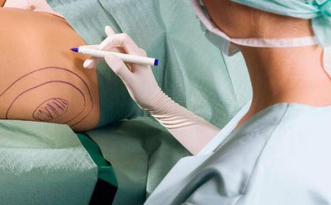 無痛吸脂是怎么做的？無痛吸脂手術(shù)價(jià)格是多少？