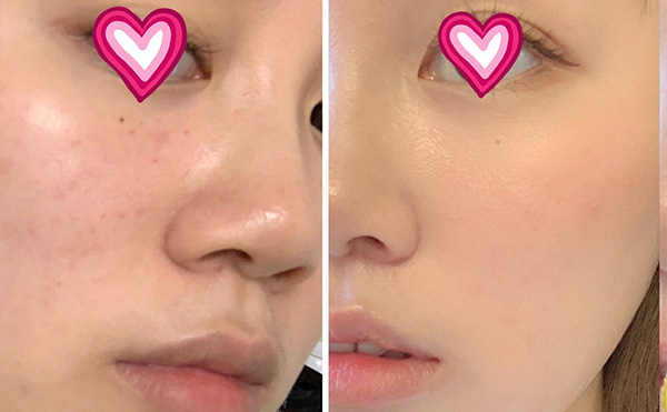 水光針多少錢?價(jià)格受哪些因素影響?