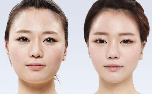 顴骨整形要多少錢？