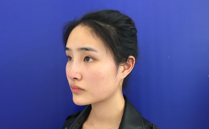 墊下巴一般多少錢？