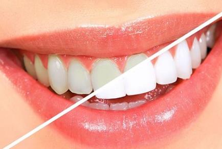 做牙冠多少錢一顆？