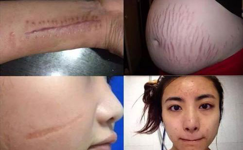 疤痕修復(fù)手術(shù)一般多少錢？