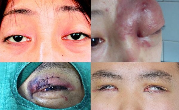 眼瞼缺失可以修復(fù)嗎?哪些人需要做眼瞼缺失矯正?