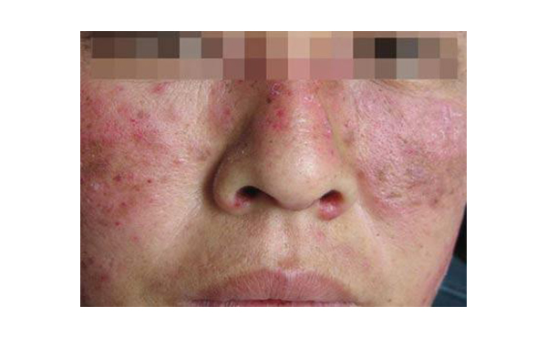 復(fù)合彩光會(huì)出現(xiàn)副作用嗎？