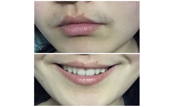 冰點(diǎn)面部脫毛會(huì)影響毛孔嗎?