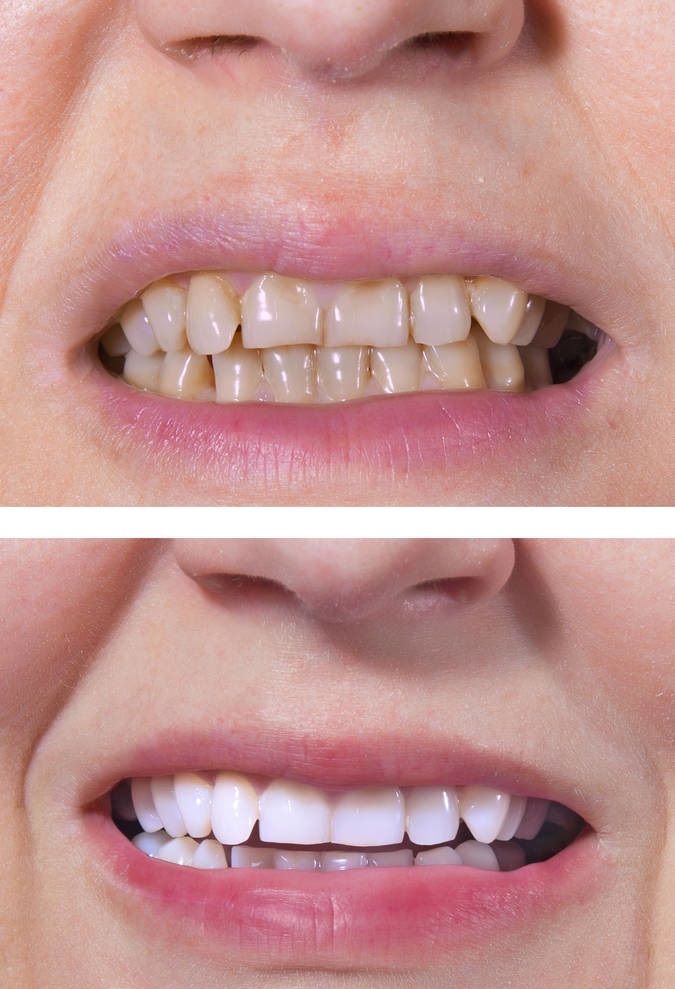 牙齒美白前后效果對(duì)比圖