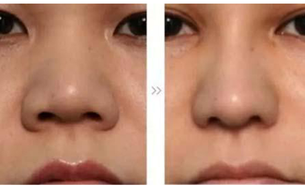 做鼻頭縮小手術有什么要求?