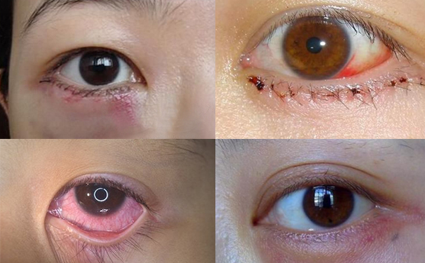 眼袋抽脂多少錢?眼袋抽脂有什么風險嗎?