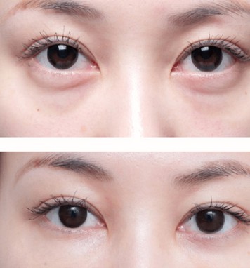 微創(chuàng)祛眼袋手術(shù)效果