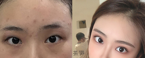蘭州亞韓做雙眼皮案例對比圖2
