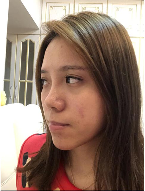 肋軟骨鼻綜合案例：術(shù)前效果