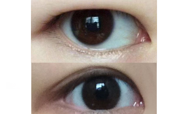 水泡眼矯正術(shù)安全不安全?一般需要多少錢?