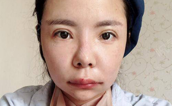 下頜角整形為什么會(huì)失敗?下頜角整容失敗如何修復(fù)?