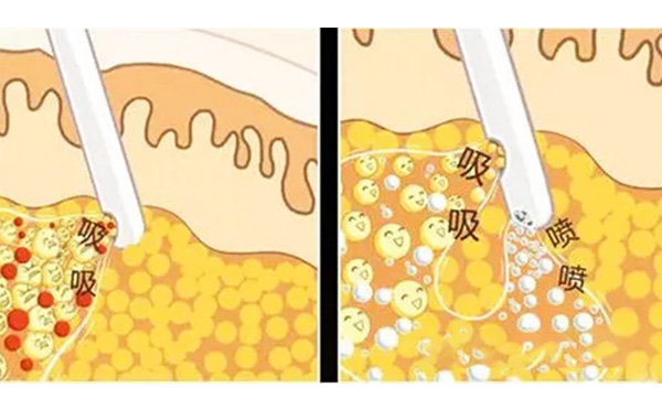 什么是水動(dòng)力吸脂？