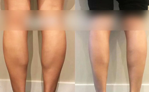 打瘦腿針是怎么操作的？