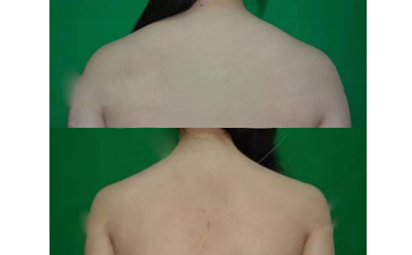 背部吸脂手術(shù)前要注意什么？