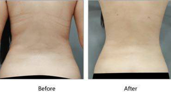 吸脂瘦背部多少錢？