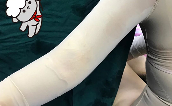 超聲波吸脂瘦手臂安全嗎？