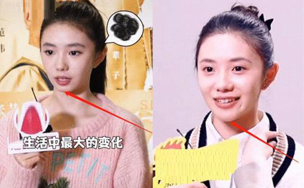 玻尿酸隆下巴整形攻略【優(yōu)勢、適宜人群、注意事項】